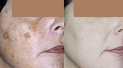 Age Spotting Treatment in Bedford, NH