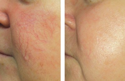 Before and after of Vascular Lesions in Bedford, NH